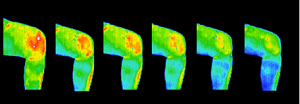 Thermography_Knee